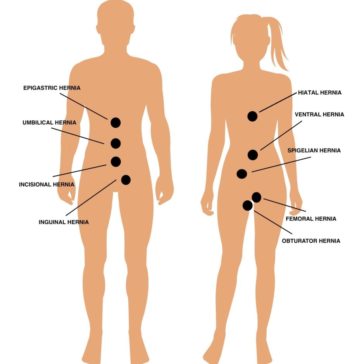 Hernia-Locations-Body