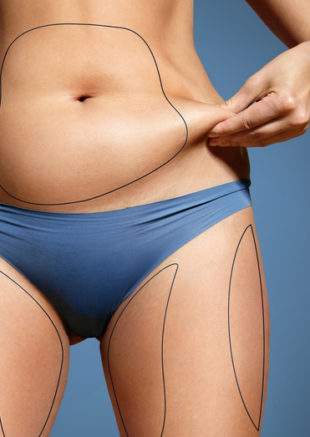 liposuction