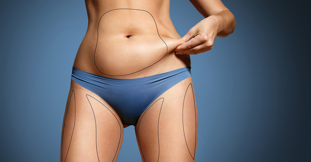 liposuction