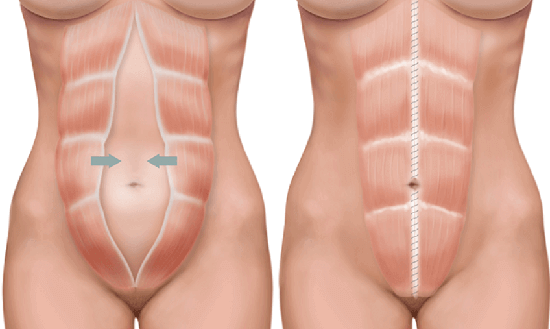 post-pregnancy-abdominoplasty-tummy-tuck-Brisbane