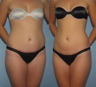 tummy tuck 1